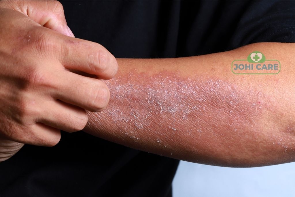 skin allergies treatment in homeopathy